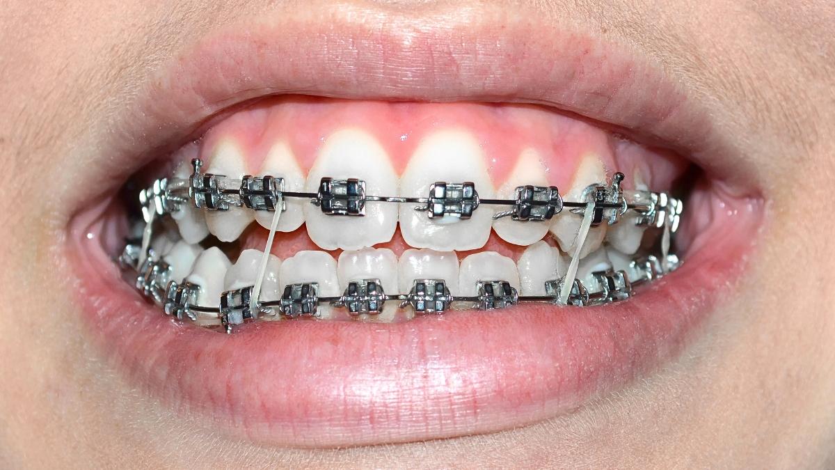 Warna Karet Behel yang Menonjol untuk Kulit Sawo Matang