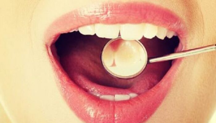 Membersihkan Karang Gigi di Puskesmas: Berapa Biayanya?