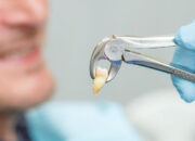 Biaya Cabut Gigi Geraham Bungsu: Info Lengkap dan Prosesnya!