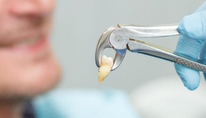 Biaya Cabut Gigi Geraham Bungsu: Info Lengkap dan Prosesnya!