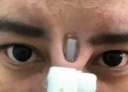 Sisi Gelap Operasi Plastik Thailand Pengen Mancung Malah Bikin Apes