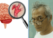 Mengenal Lebih Jauh Kondisi Tubuh Saat Pembuluh Darah Pecah Bahkan Bisa Gara-Gara Bersin